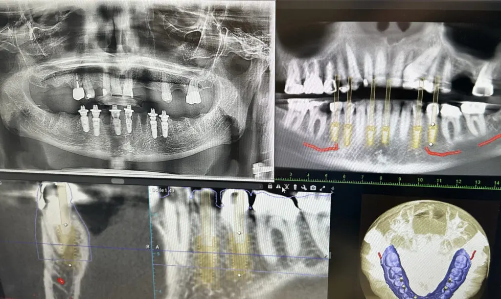dental implants