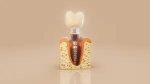 Explore your options for dental implants in Farmington, MI