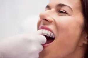 Learn about clear aligners in Farmington.