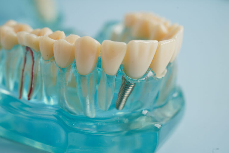 Dental implant, artificial tooth roots into jaw, root canal of dental treatment, gum disease, teeth model for dentist studying about dentistry.