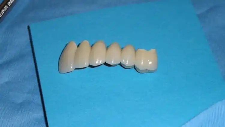 dental bridge