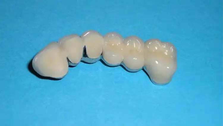 dental bridge